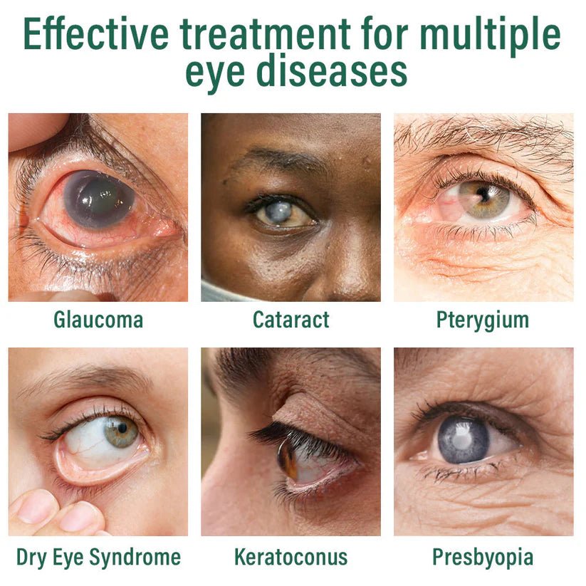 OcuVive® Nano Eye Drops Serum 👩‍⚕️ Ophthal mologists Recommended (Suitable for presbyopia, dry eye syndrome, glaucoma, cataracts and diabetic retinopathy) 🍀 - Aggil Express